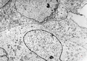 F,49y. | rhabdomyosarcoma - pankreas